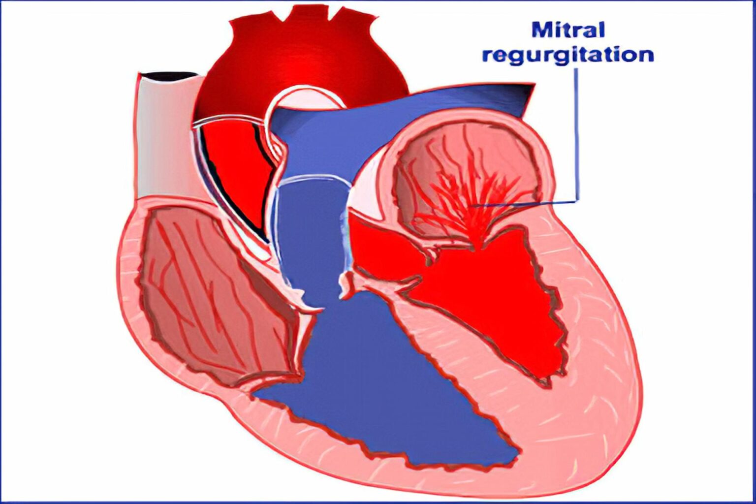 how-do-you-treat-mitral-valve-regurgitation