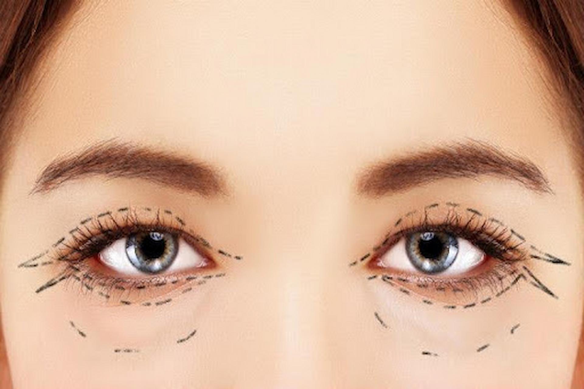 blepharoplasty